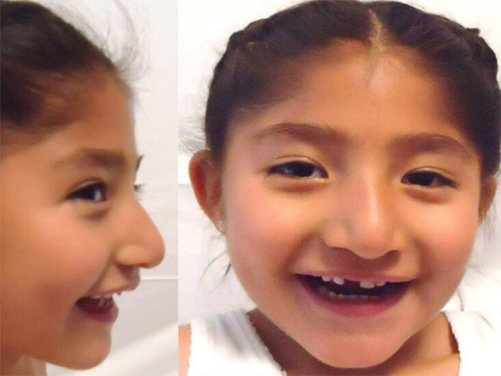 Angelman syndrome in a 5 y Mexican