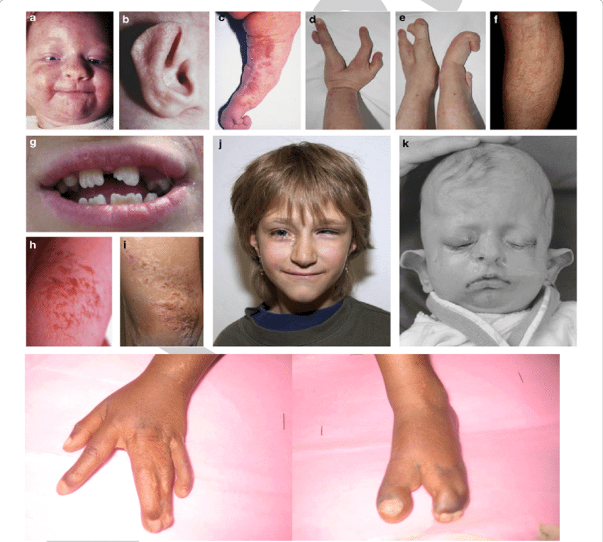 An overview of Goltz syndrome clinical features