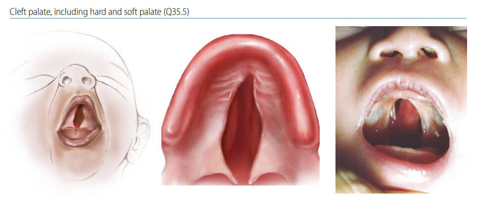 Cleft palate