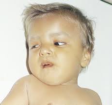 a boy manifesting silver-gray hair-a hallmark sign of Elejalde syndrome