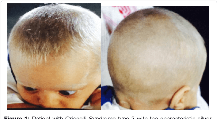 Patients manifesting  Griscelli syndrome