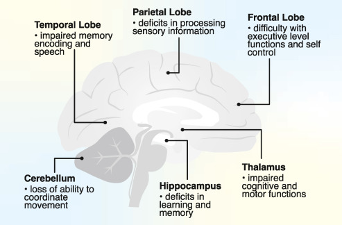 Effects of alcohol on the brain