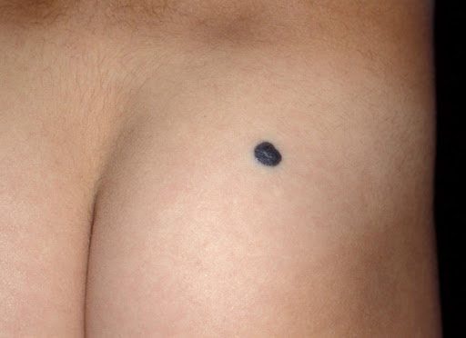 intradermal nevus in a patient