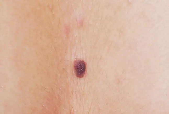 two junctional nevi that appear as uniformly brown small macules, round in shape with smooth regular borders