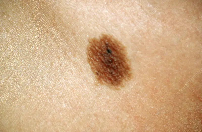 intradermal nevus in a patient