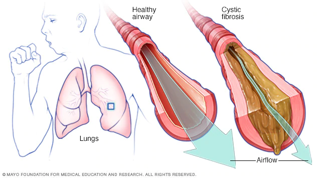 graphic representation of cystic fibrosis symptom