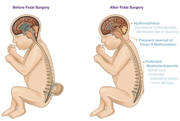 fetal surgery repairs spina bifida