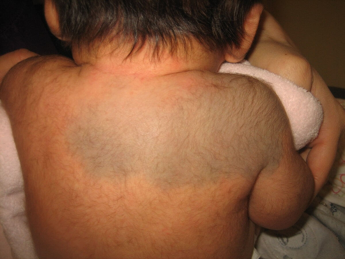 a child present with nevus of Ito