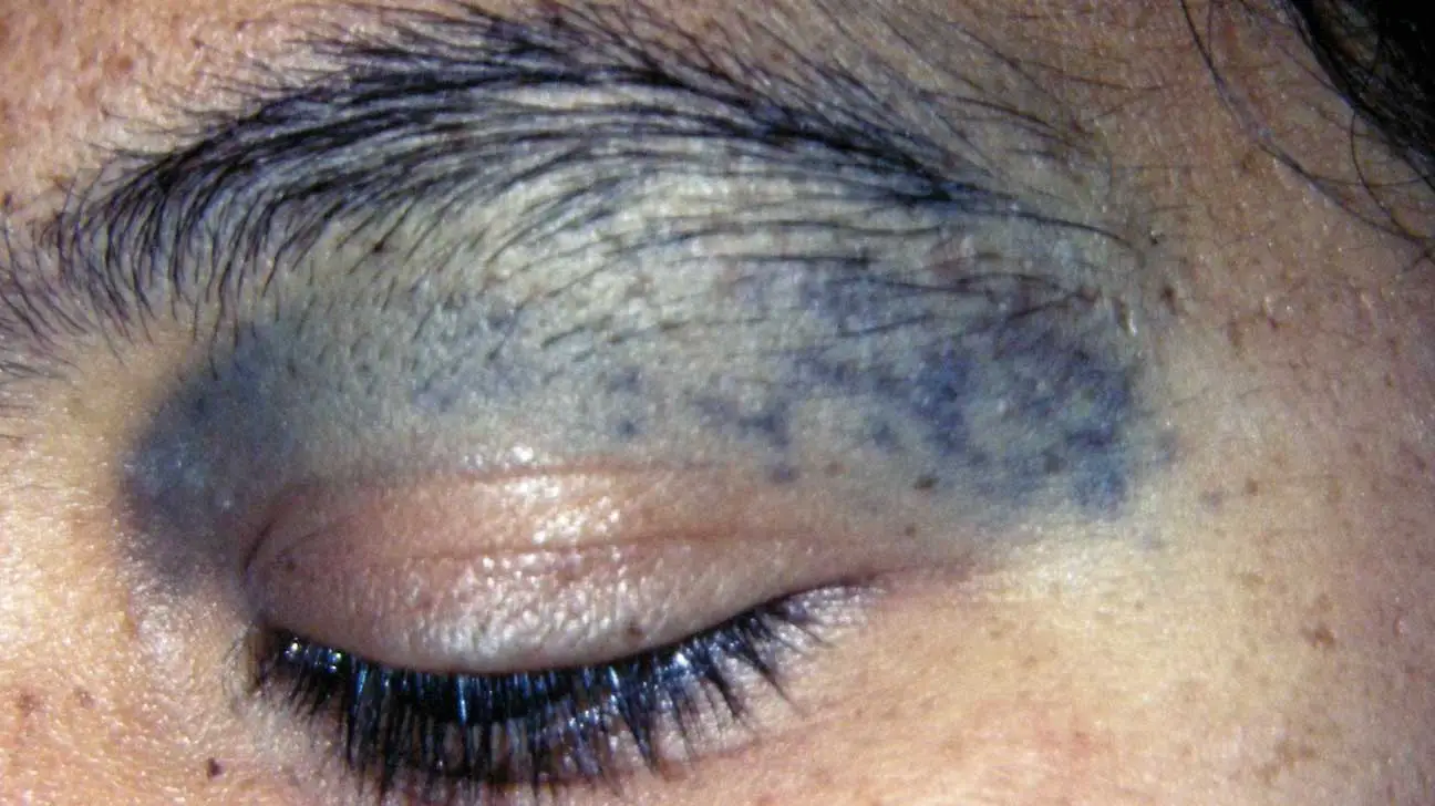 Clinical-findings-in-a-female-patient-with-nevus-of-Ota-A-Slate-gray-patches-affecting