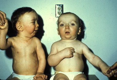 an infant with Sotos syndrome