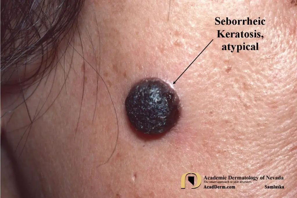 Seborrheic Keratosis Symptoms And Cosmetic Care —viquepedia